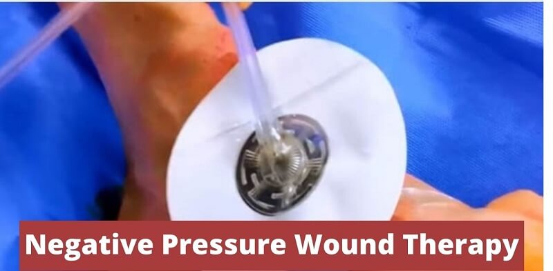 negative pressure wound therapy definition