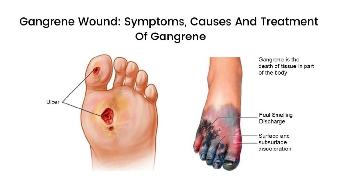 What Is Gangrene And How It Gets Treated?